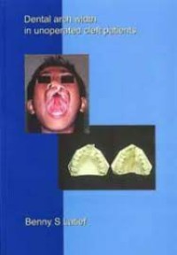 Image of Dental Arch Width In Unoperated Cleft patients