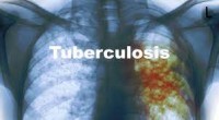 Image of Tuberculosis