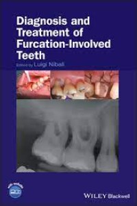 Image of Diagnosis And Treatment Of Furcation-Involved Teeth (e-Book)